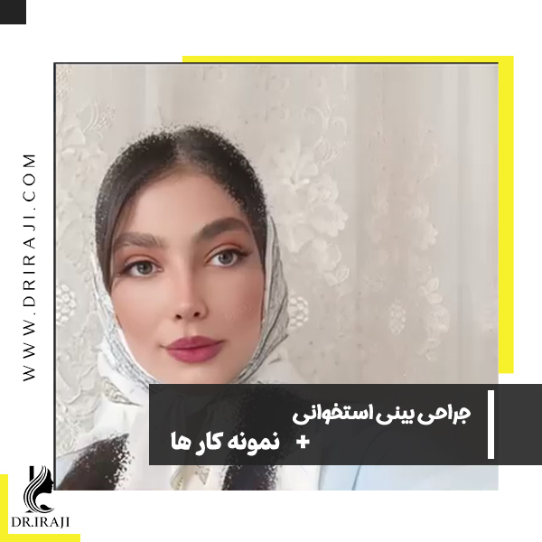 عمل بینی استخوانی در اصفهان - دکتر ایرجی