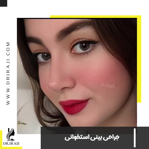 عمل بینی استخوانی در اصفهان - دکتر ایرجی