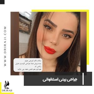 جراحی بینی استخوانی در اصفهان - دکتر ایرجی