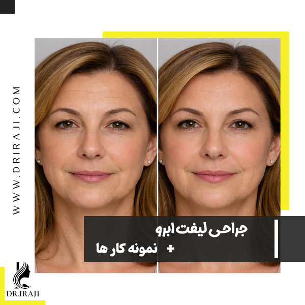 جراحی لیفت ابرو در اصفهان - دکتر ایرجی