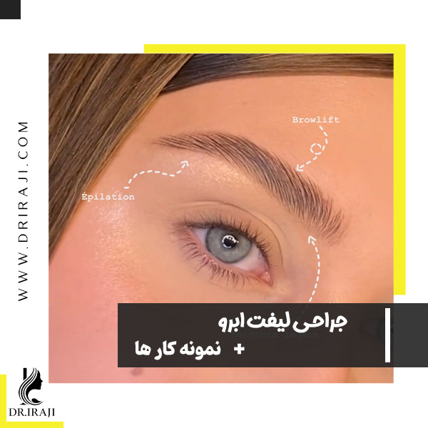 جراحی لیفت ابرو در اصفهان - دکتر ایرجی