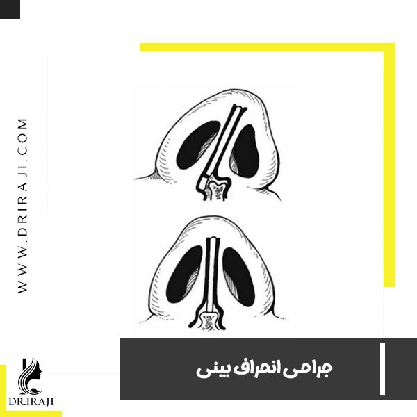 جراحی انحراف بینی - دکتر ایرجی