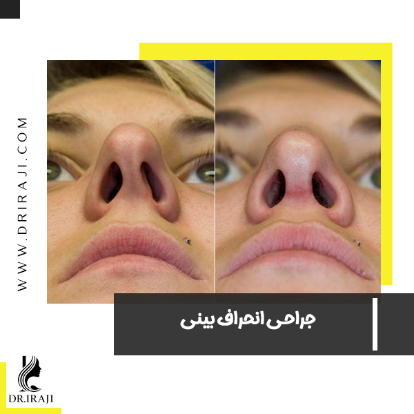 جراحی انحراف بینی در اصفهان - دکتر ایرجی