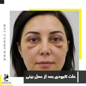 علت کبودی بعد از عمل بینی + درمان کبودی صورت بعد عمل بینی