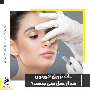 علت تزریق کورتون بعد از عمل بینی چیست؟