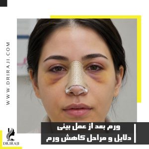دلایل ورم بعد از عمل بینی + مراحل و روش کاهش ورم بینی بعد از عمل