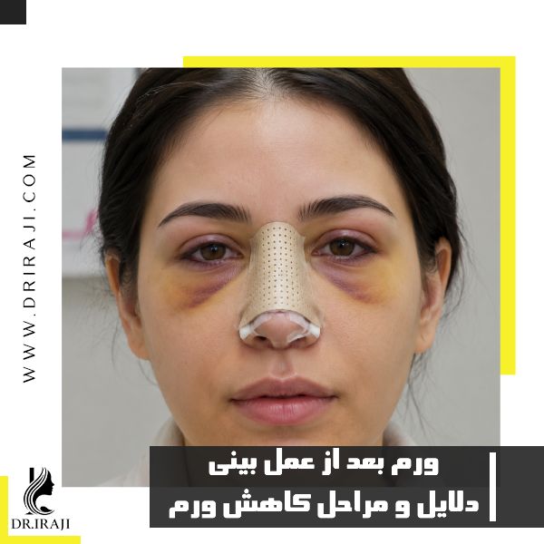 دلایل ورم بعد از عمل بینی + مراحل و روش کاهش ورم بینی بعد از عمل