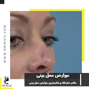 عوارض عمل بینی چیست؟ علائم خطرناک و شایعترین عوارض عمل بینی