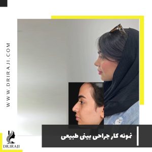 قبل و بعد از جراحی بینی طبیعی