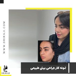 قبل و بعد از جراحی بینی طبیعی