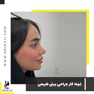 بینی طبیعی عمل شده