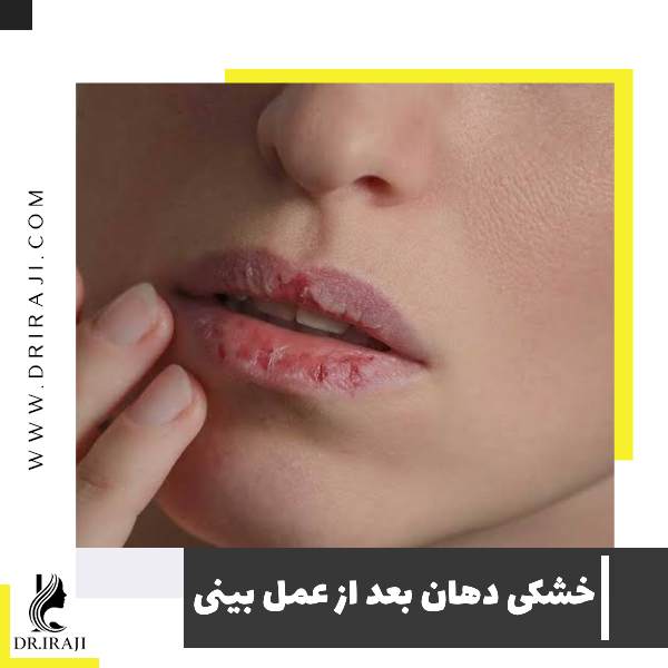 خشکی دهان بعد از عمل بینی