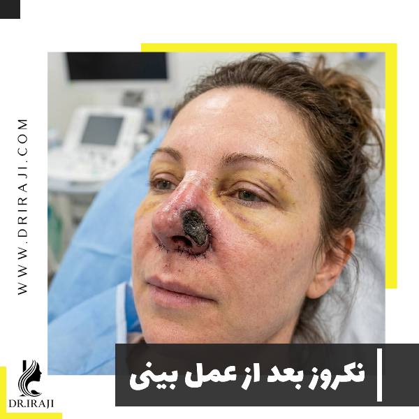 نکروز بعد از عمل بینی