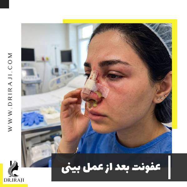 عفونت بعد از عمل بینی